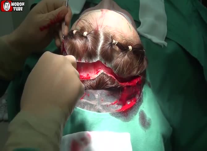 Video :A patient was scalped on camera by a surgeon (public knowledge)